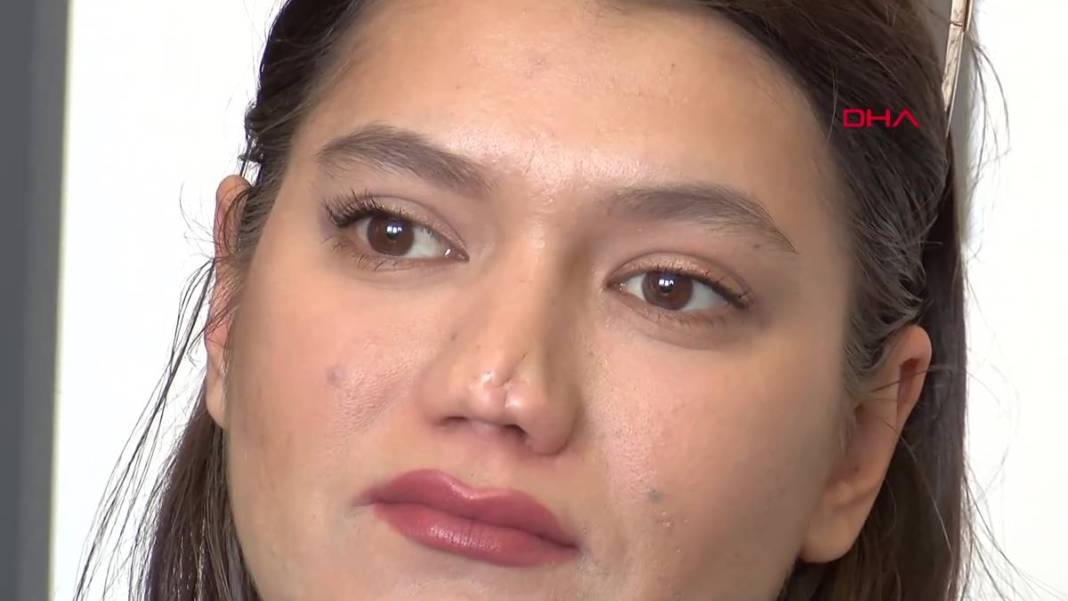 Estetik operasyon sonrası burnu düştü! Aynı doktora iki ameliyat oldu, sonuç değişmedi, mahkemeye verdi 8